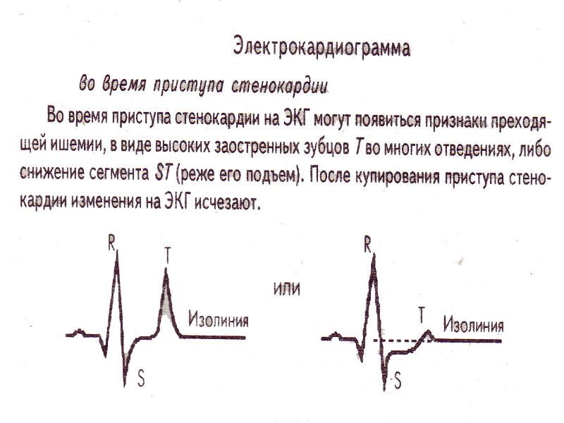 Ибс стенокардия карта вызова