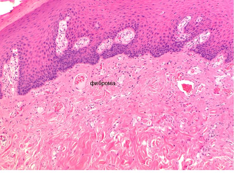 Фиброма гистология фото