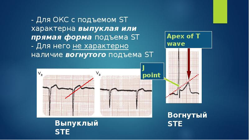 Презентация окс без подъема st