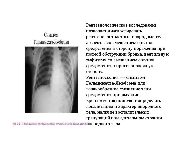 Инородное тело бронхов карта вызова