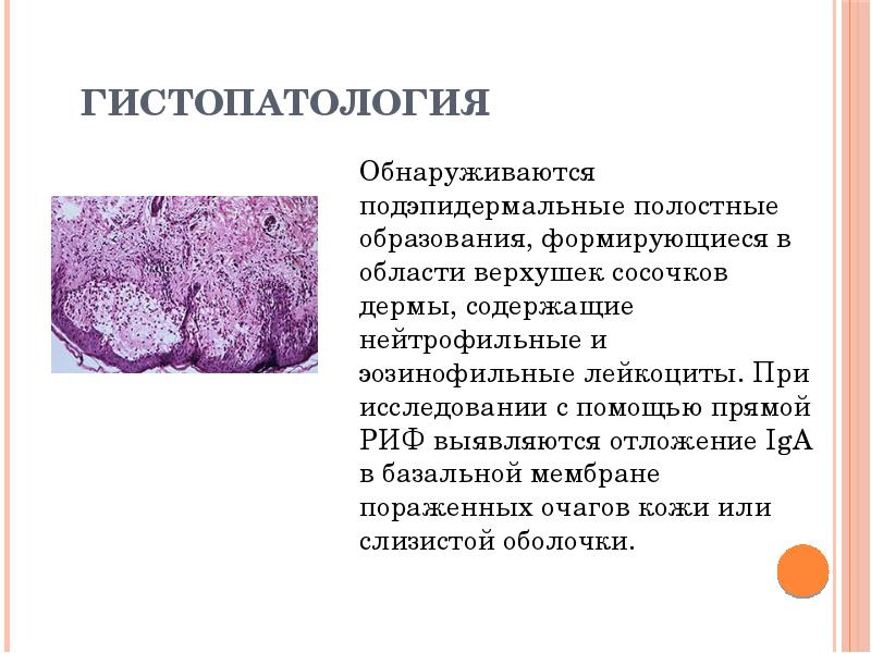 Гистопатология Обнаруживаются подэпидермальные полостные образования, формирующиеся в области верхушек сосочков дермы,