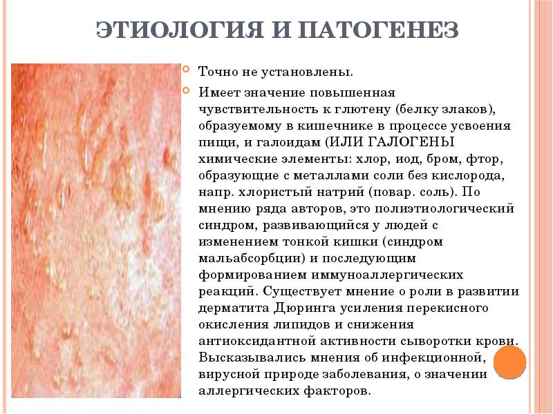 Этиология и патогенез Точно не установлены.  Имеет значение повышенная чувствительность
