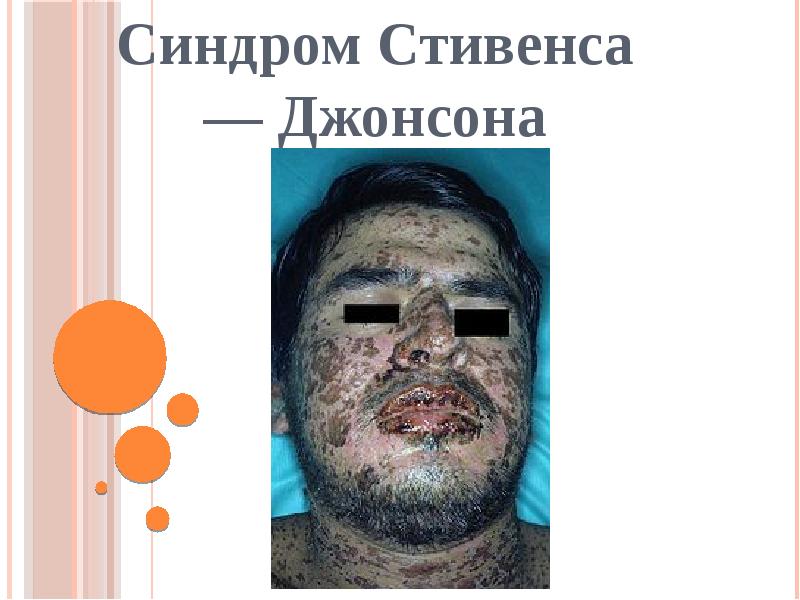 Синдром Стивенса — Джонсона