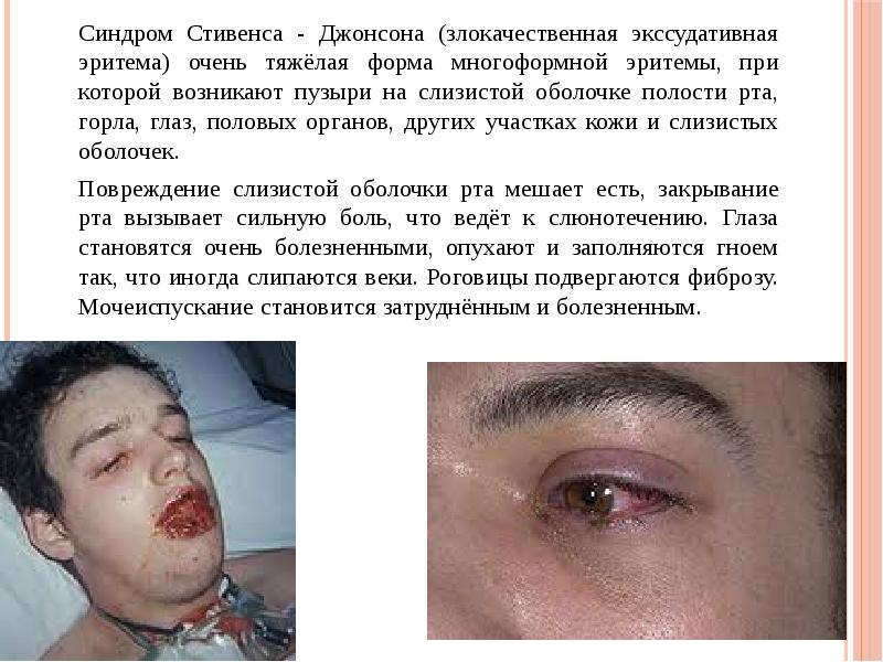 Синдром Стивенса - Джонсона (злокачественная экссудативная эритема) очень тяжёлая форма многоформной
