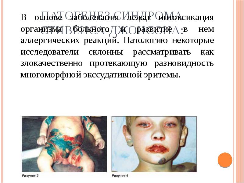 Патогенез Синдрома стивенса-джонсона: В основе заболевания лежат интоксикация организма больного и