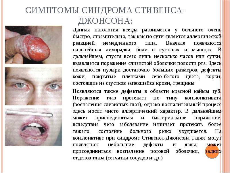 Симптомы Синдрома стивенса-джонсона: Данная патология всегда развивается у больного очень быстро,