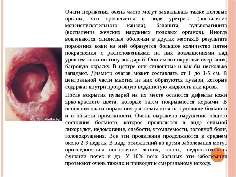 Очаги поражения очень часто могут захватывать также половые органы, что проявляется
