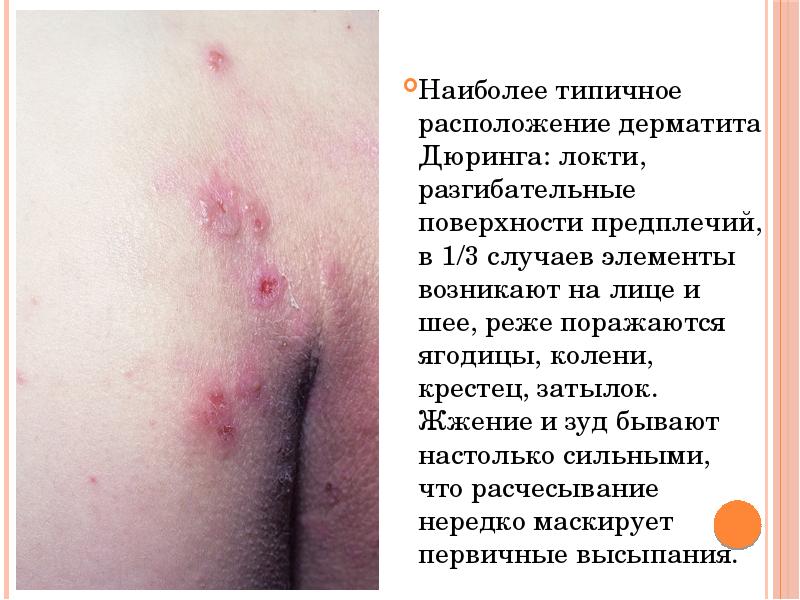 Наиболее типичное расположение дерматита Дюринга: локти, разгибательные поверхности предплечий, в 1/3