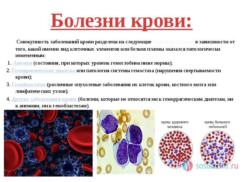 Заболевания крови презентация