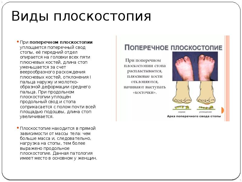 Опущение сводов стопы. Поперечный свод стопы кости. Мышцы поперечного свода стопы. Плоскостопие поперечного свода стопы. Поперечный свод стопы образован.