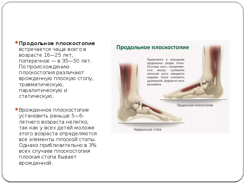 Продольное плоскостопие углы. Продольное плоскостопие. Травматическое плоскостопие. Врожденное плоскостопие. Продольное и поперечное плоскостопие.