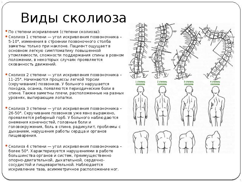 Степени сколиоза по градусам фото