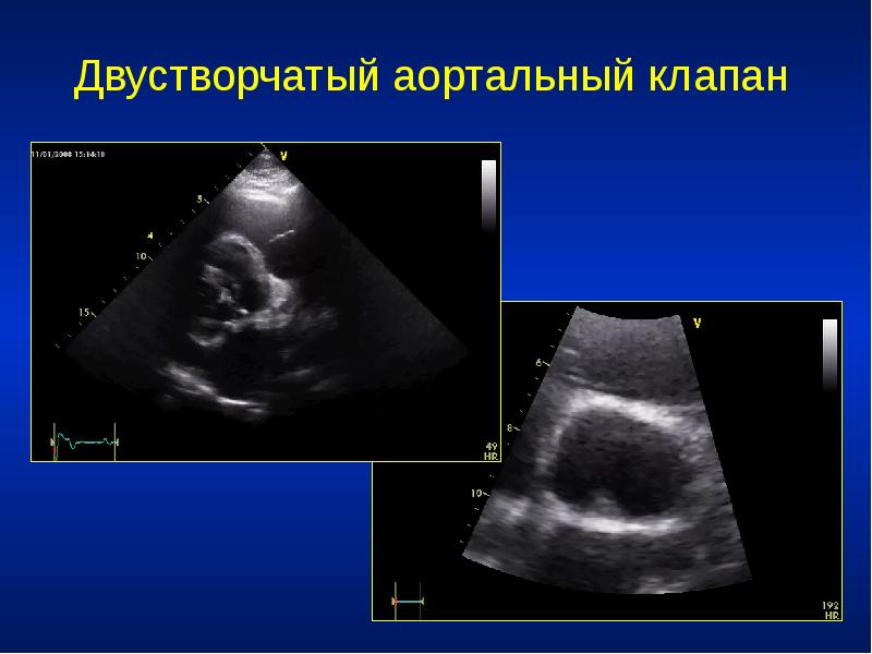 Двустворчатый аортальный клапан классификация