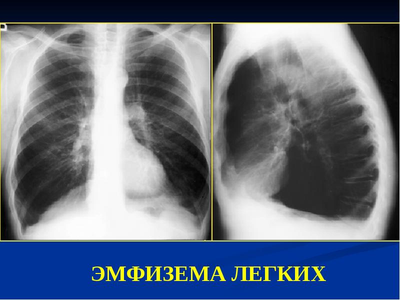 Рентгенологическая картина при хобл