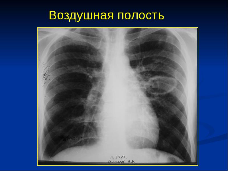 Буллы в легких рентгенологическая картина