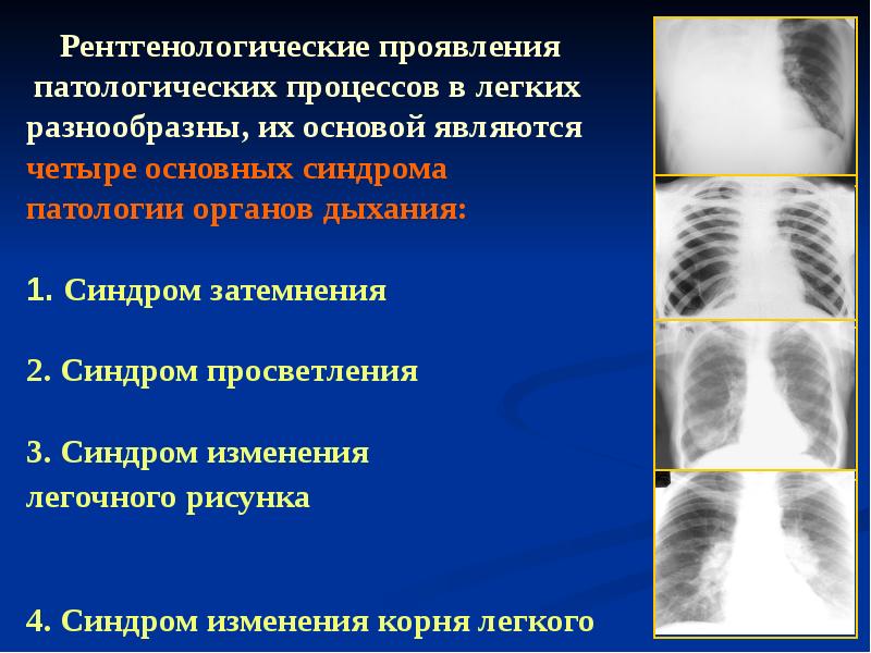 Изменения легочного и корневого рисунка