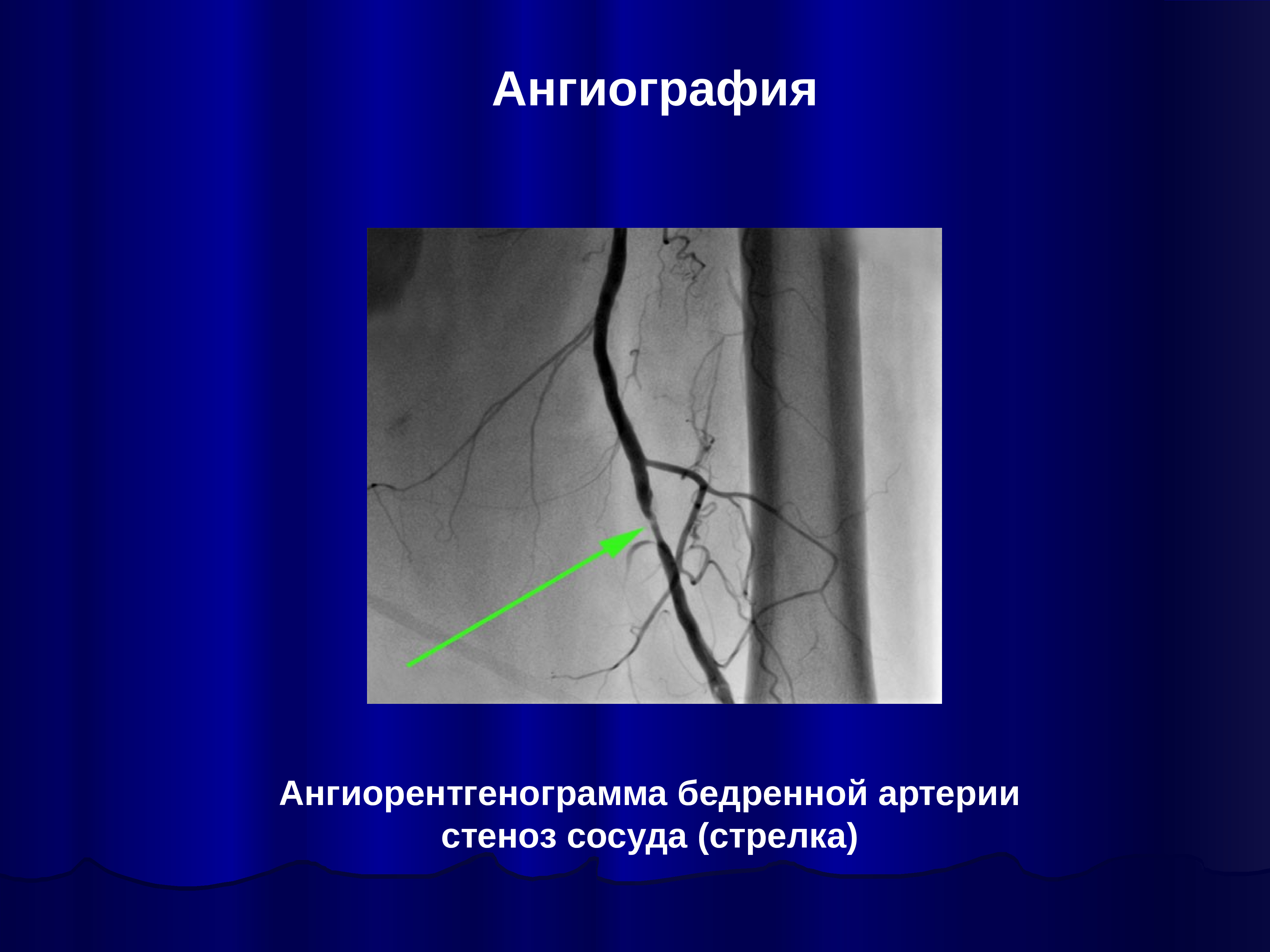 Тромбоз бедренной артерии