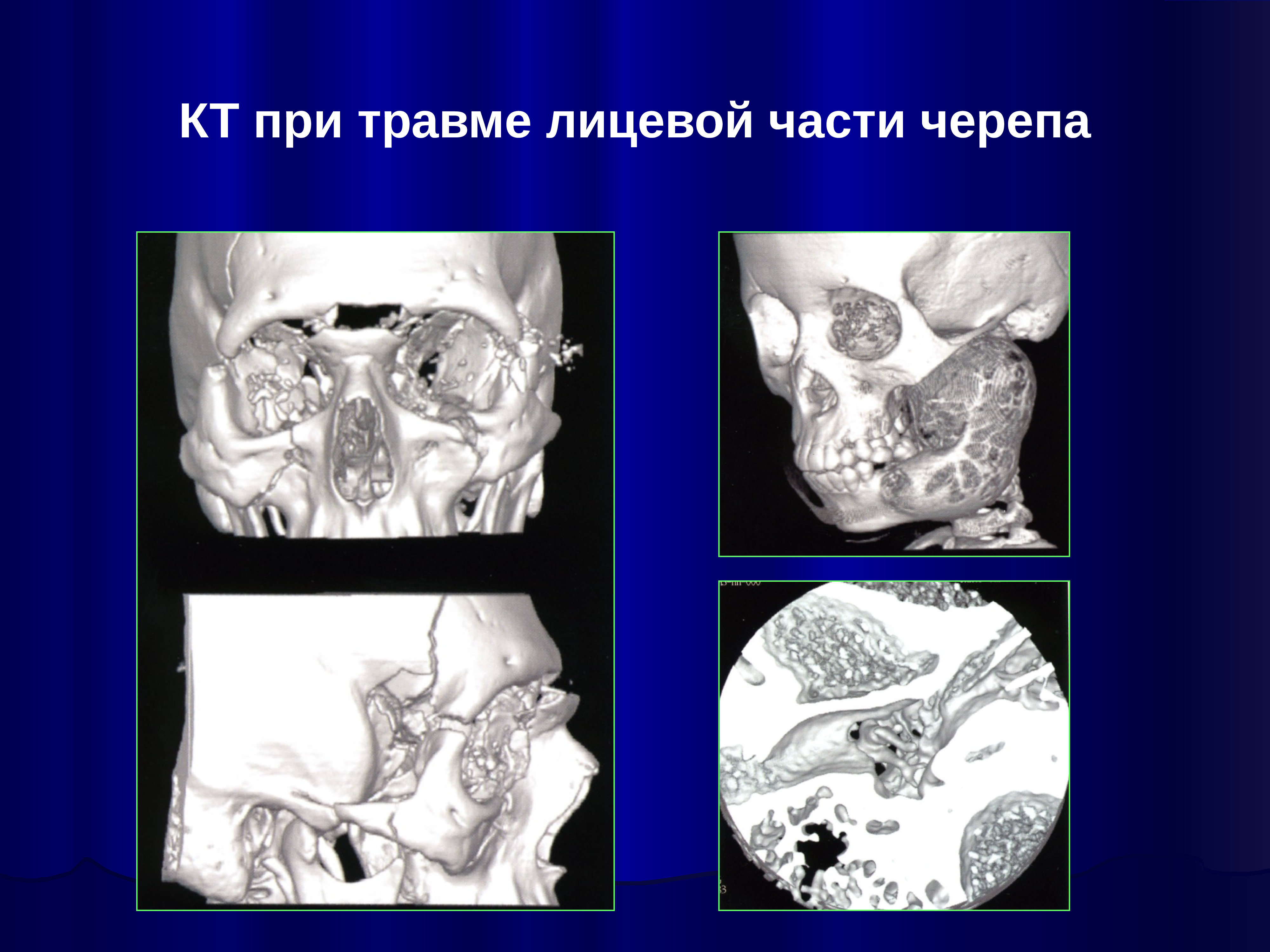 Диагноз костей. Рентгенодиагностика повреждений лицевого черепа. Травмы лицевого черепа диагностика кт.