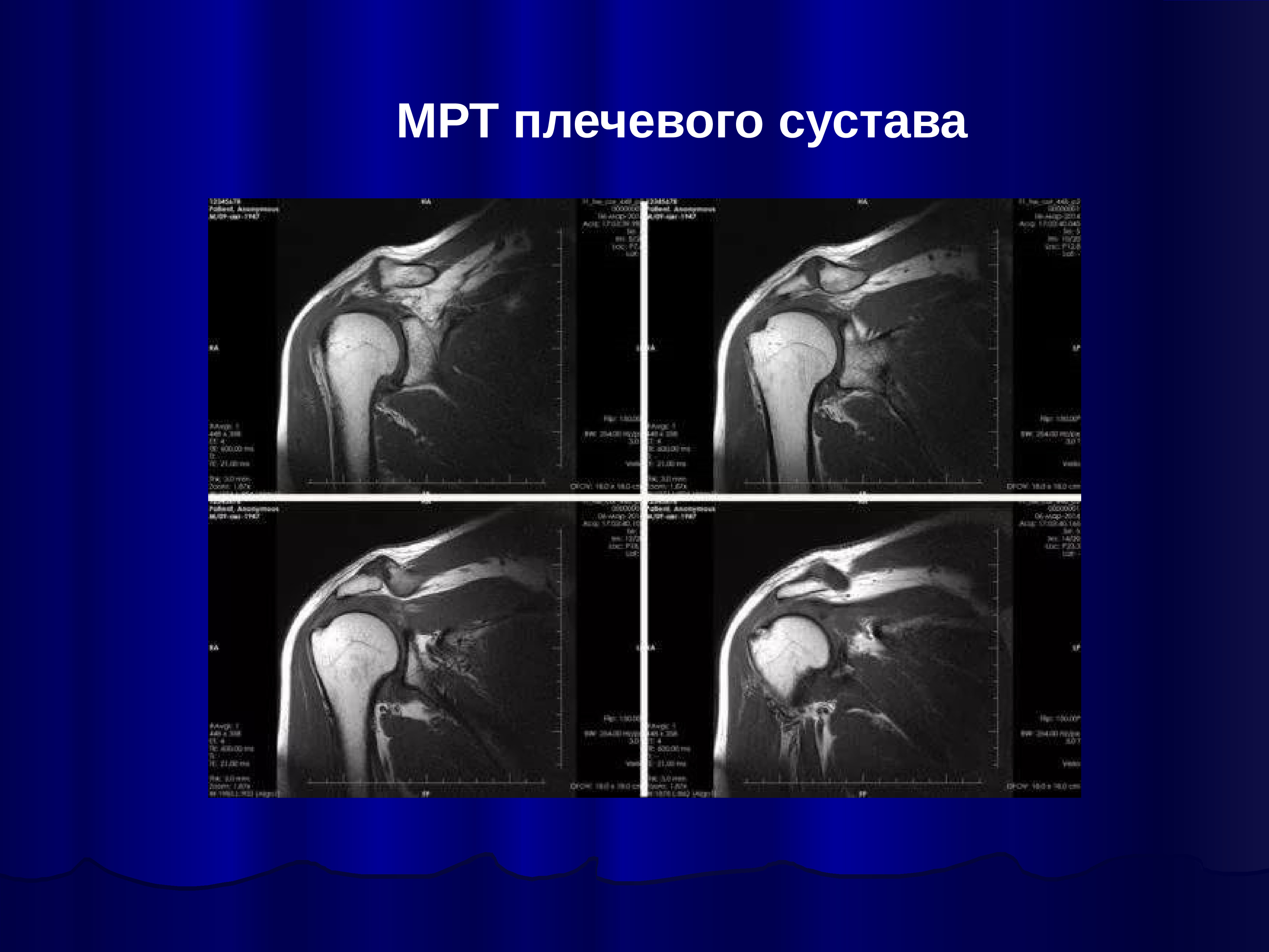 Мрт плечевого. Мрт мягких тканей плечевого сустава. Мрт правого плечевого сустава. Мрт здорового плечевого сустава.