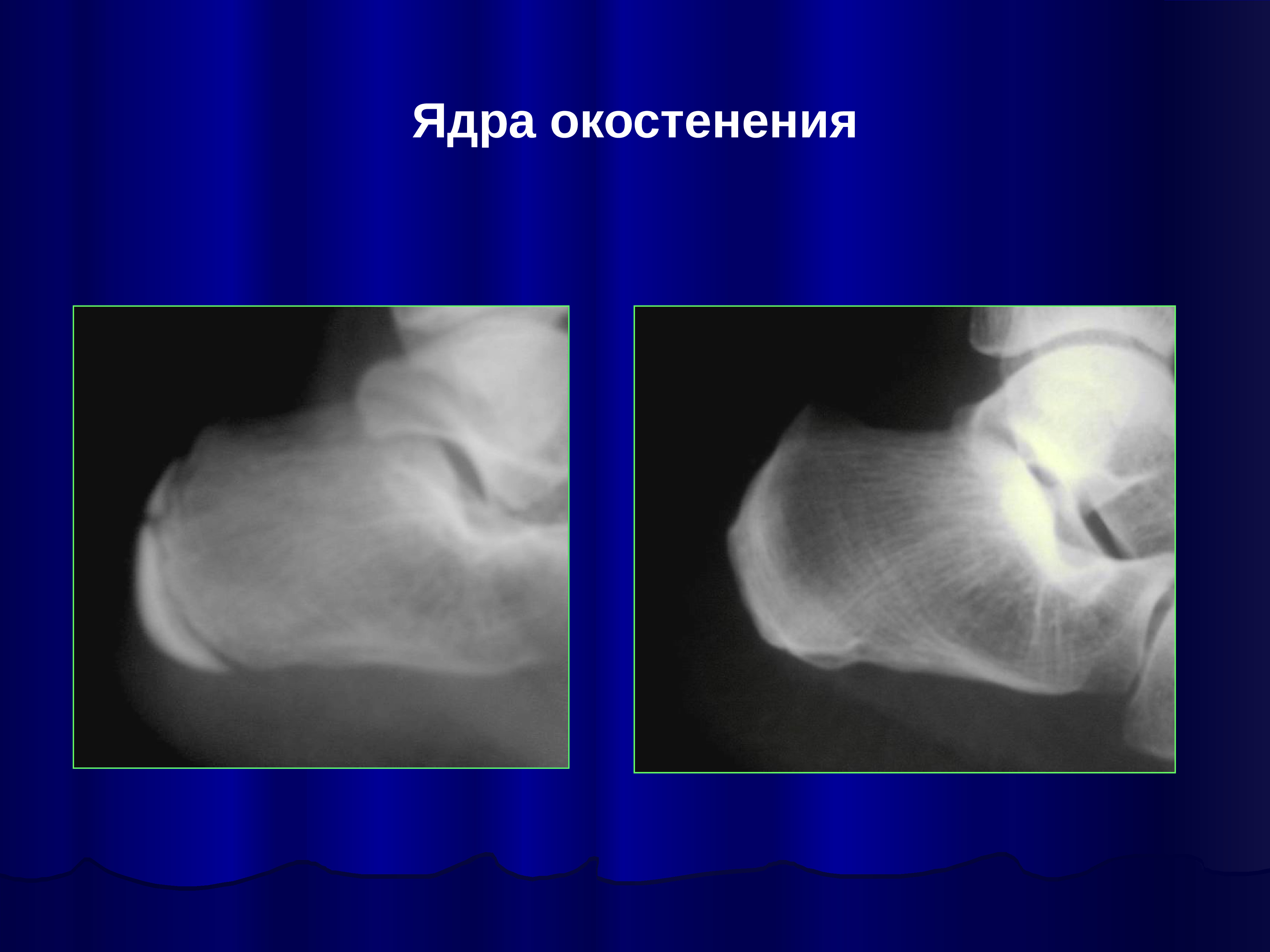 Ядра окостенения тазобедренных суставов. Ядро окостенения тазобедренного сустава УЗИ. Асимметрия ядер окостенения головок бедренных костей. Ядра окостенения на рентгене.