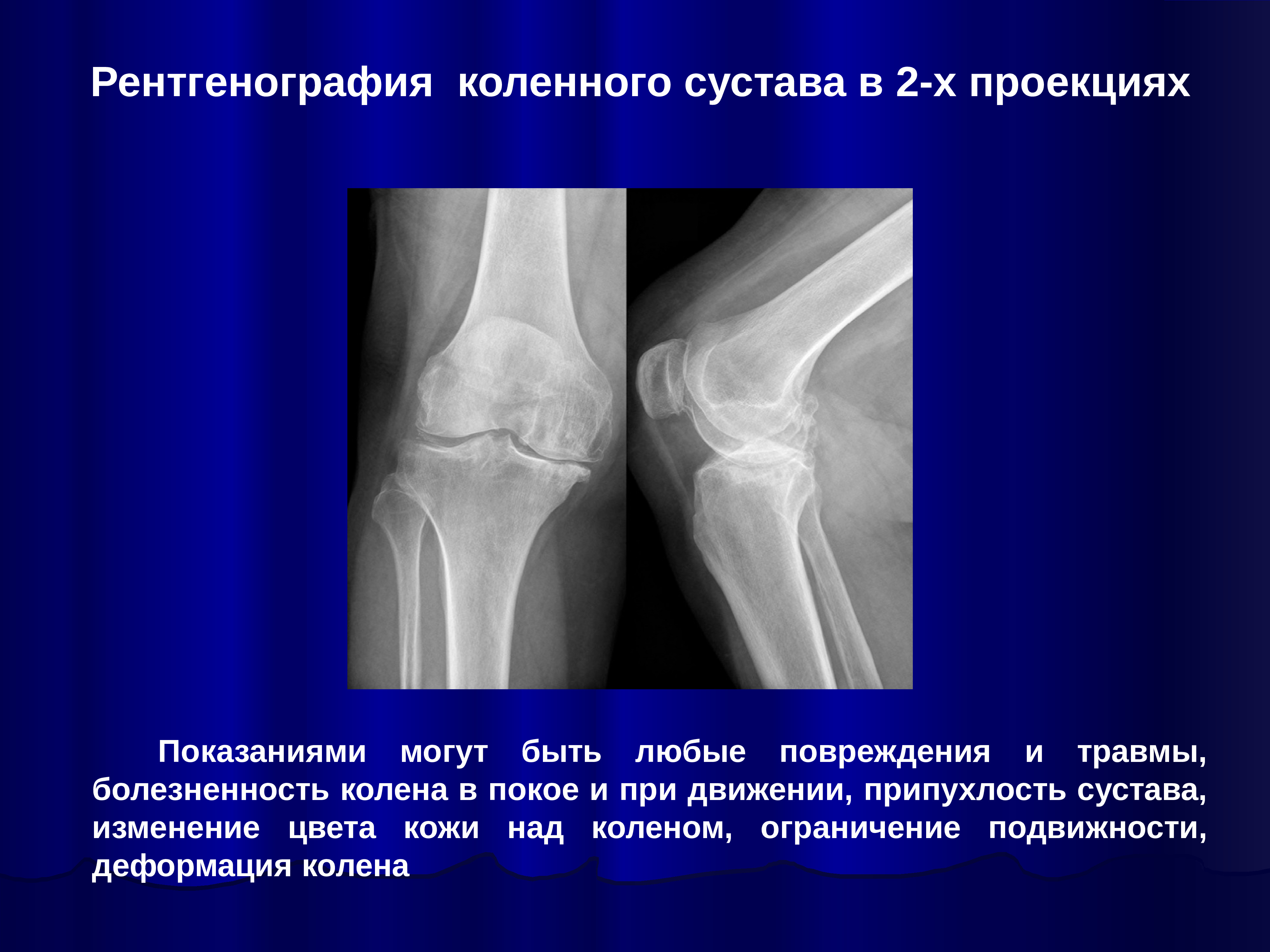 Рентген колена. Коленный сустав в 2 проекциях рентген. Рентген коленного сустава с функциональными пробами. Рентген нормального коленного сустава. Рентген снимок коленного сустава в норме.