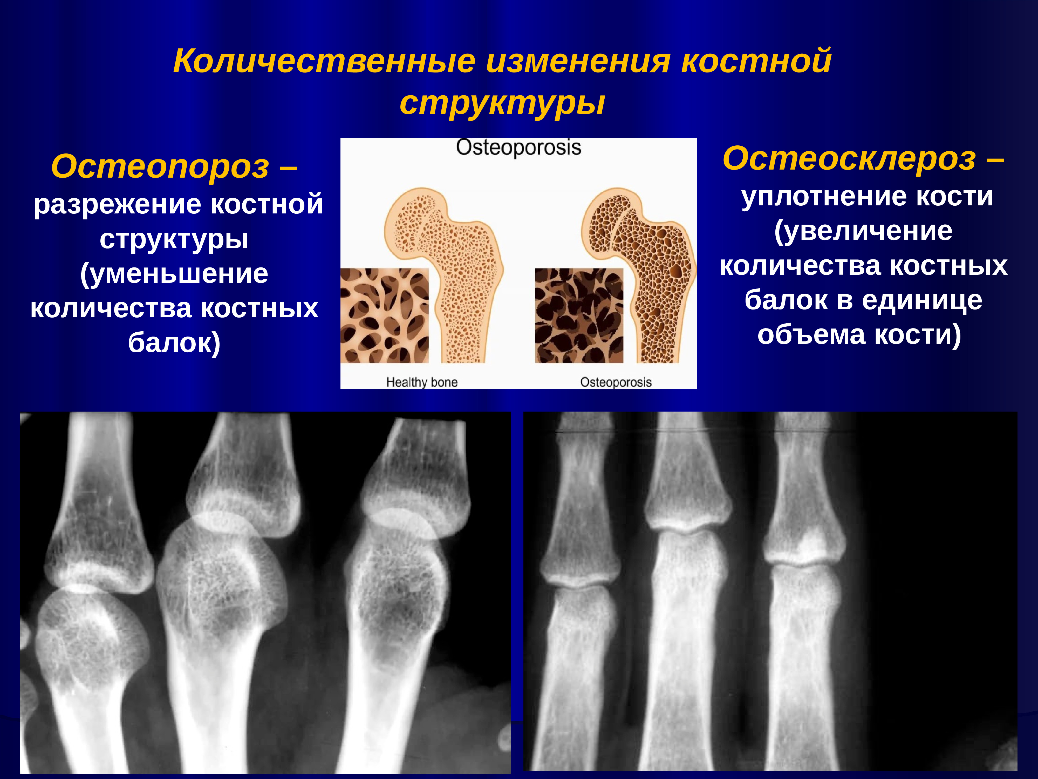 Структурные изменения костей. Остеопороз и остеосклероз на рентгене. Остеосклероз кости рентген. Остеосклероз позвоночника рентген. Очаговый остеосклероз большеберцовой кости.