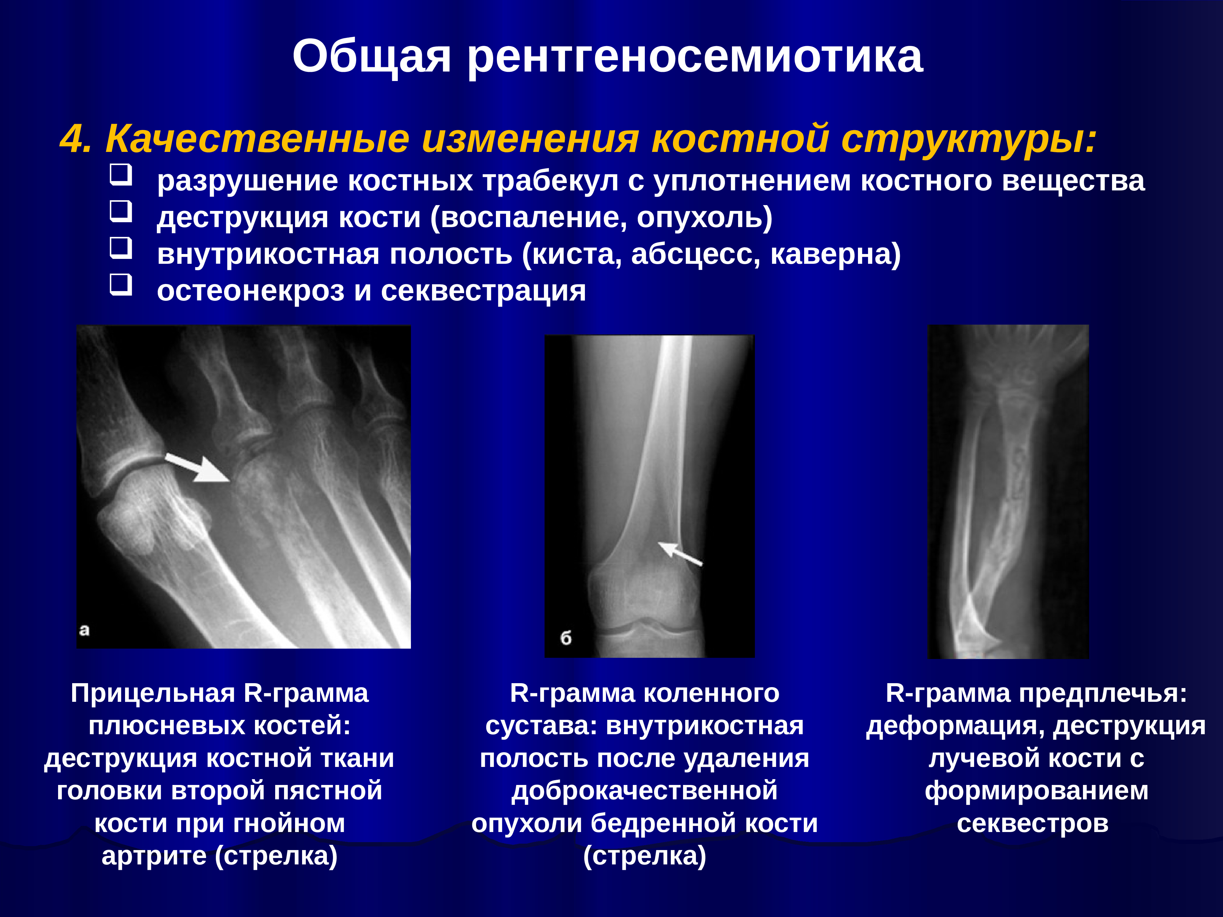 Изменение структуры кости. Рентгенологические синдромы костно-суставной патологии. Синдромы костно-суставной системы лучевая диагностика. Деструкция кости и остеопороз. Лучевые синдромы костей.