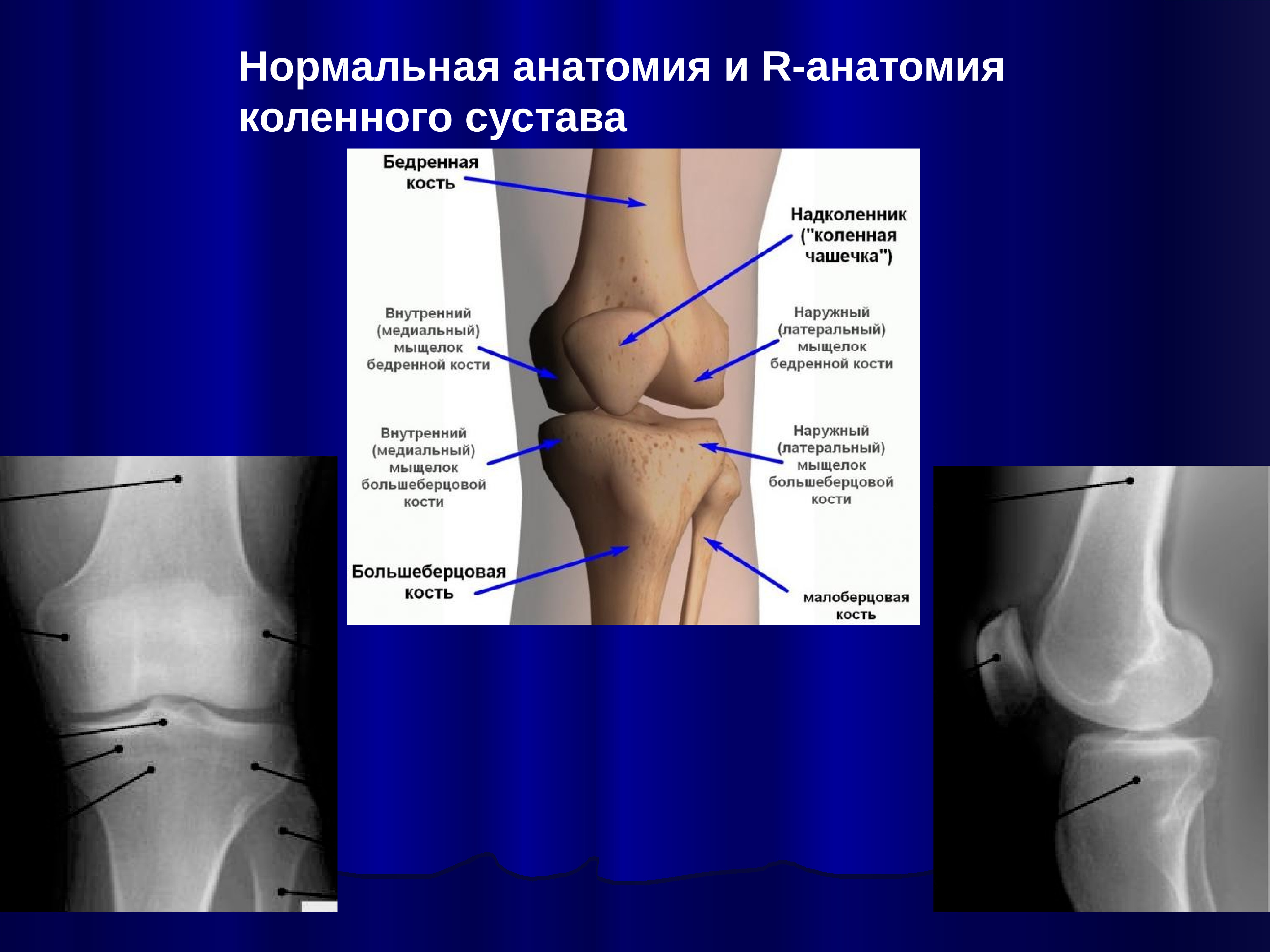 Наружный мыщелок. Анатомия коленного сустава кости. Анатомия коленного сустава мыщелки. Медиальный мыщелок бедренной кости. Внутренний мыщелок большеберцовой кости.