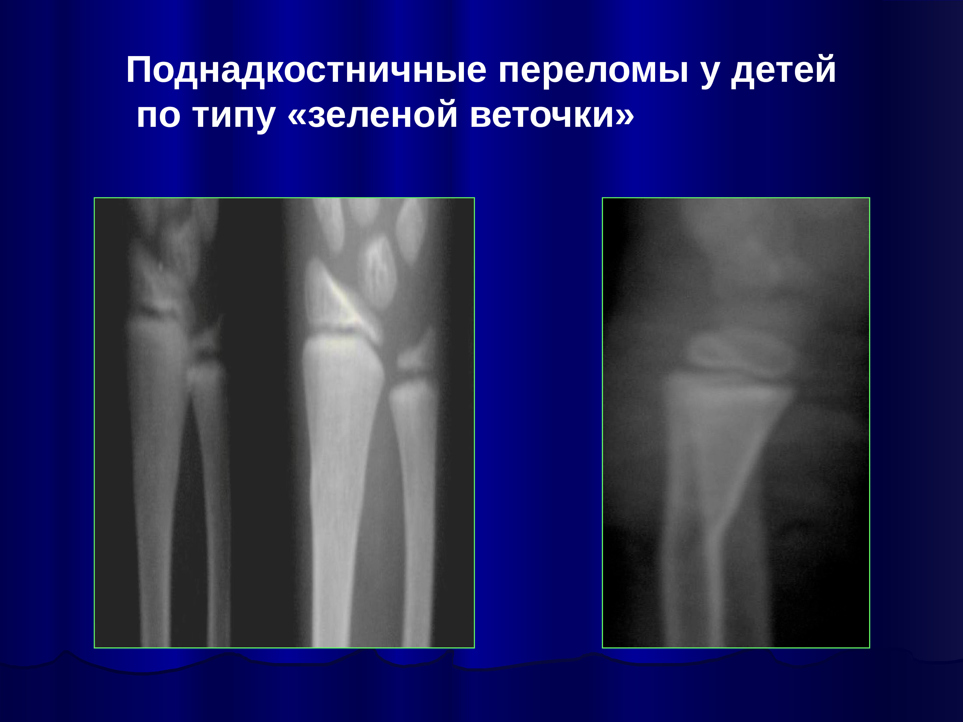 Перелом костей у детей. Поднадкостничный перелом по типу зеленой веточки. Перелом по типу зеленой веточки рентген. Перелом типа зелёная ветка рентген. Поднадкостничный перелом у детей по типу зеленой веточки.