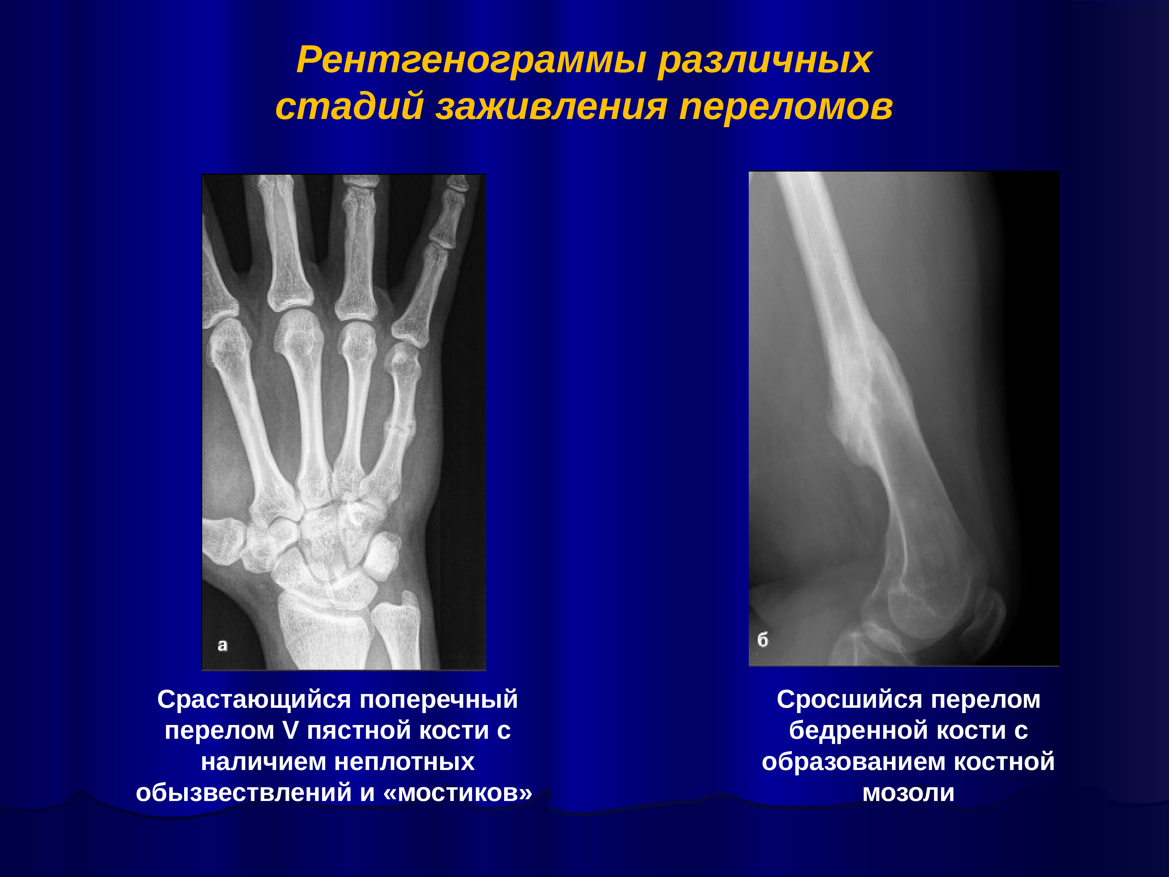 Рентгенологические стадии заживления перелома кости