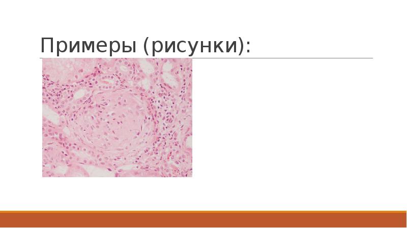 Трубная беременность микропрепарат. Интракапиллярный гломерулонефрит микропрепарат. Интракапиллярный пролиферативный гломерулонефрит микропрепарат. Интракапиллярный продуктивный гломерулонефрит микропрепарат. Хронический гломерулонефрит микропрепарат рисунок.