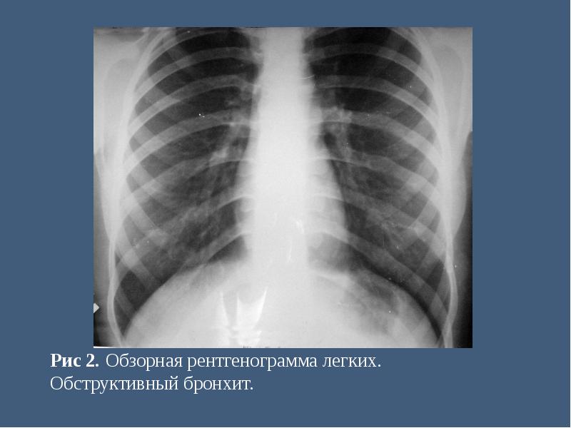 Рентген бронхита легких фото