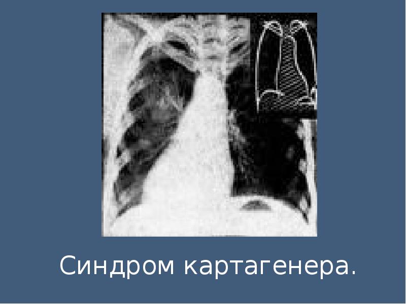 Синдром картагенера презентация