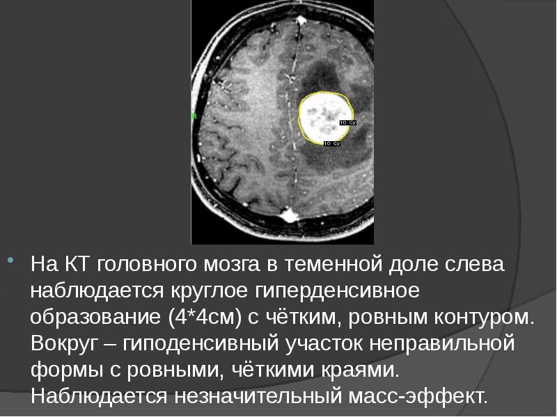 На КТ головного мозга в теменной доле слева наблюдается круглое гиперденсивное На КТ головного мозга в теменной доле слева наблюдается круглое гиперденсивное
