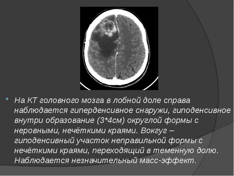 На КТ головного мозга в лобной доле справа наблюдается гиперденсивное снаружи, На КТ головного мозга в лобной доле справа наблюдается гиперденсивное снаружи,