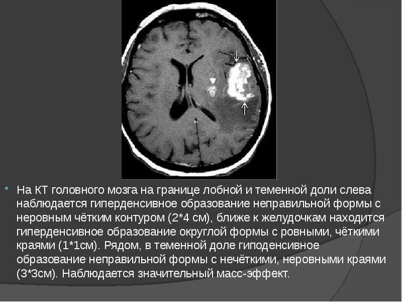 На КТ головного мозга на границе лобной и теменной доли слева На КТ головного мозга на границе лобной и теменной доли слева