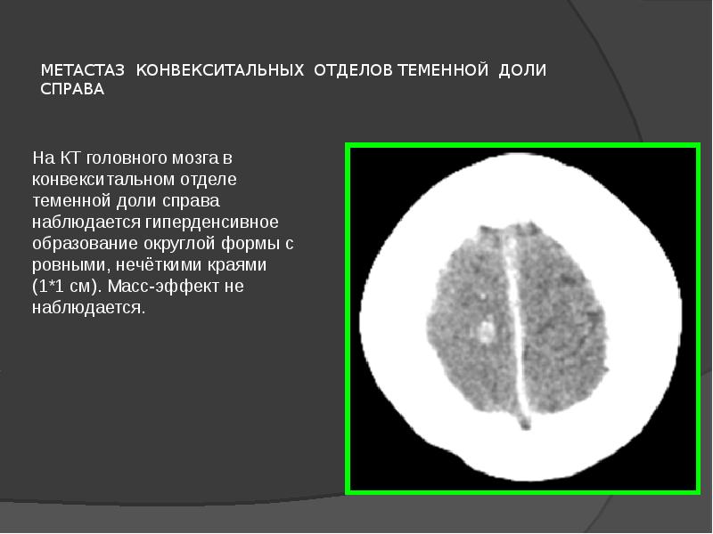 МЕТАСТАЗ КОНВЕКСИТАЛЬНЫХ ОТДЕЛОВ ТЕМЕННОЙ ДОЛИ СПРАВА
