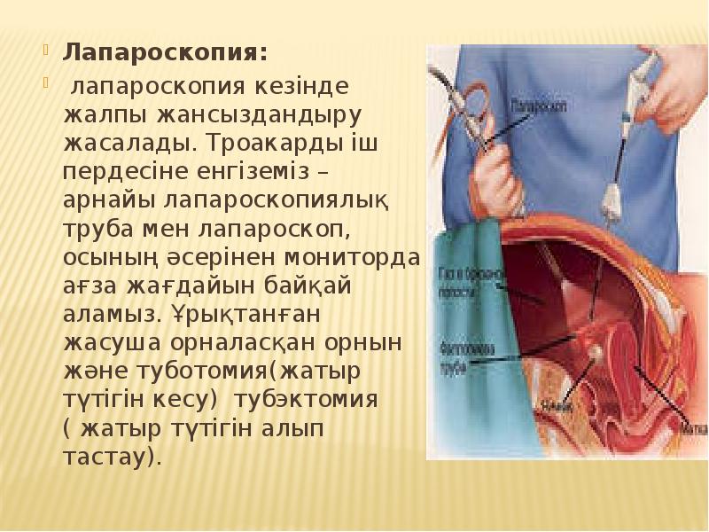 Лапароскопия:
Лапароскопия:
лапароскопия кезінде жалпы жансыздандыру жасалады. Троакарды іш пердесіне Лапароскопия:
Лапароскопия:
лапароскопия кезінде жалпы жансыздандыру жасалады. Троакарды іш пердесіне