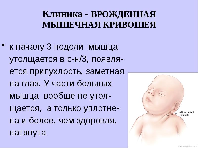 Последствия кривошеи