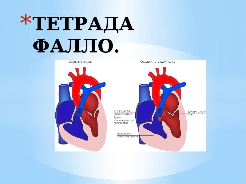 Триада фалло презентация