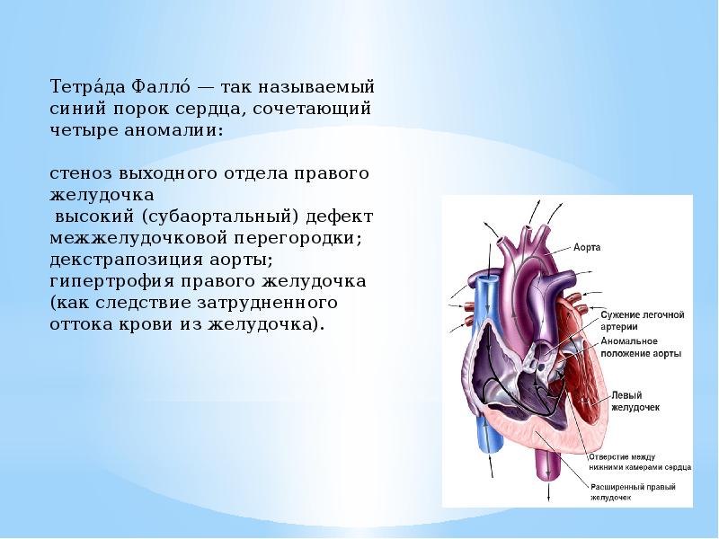 Тетрада фалло презентация педиатрия