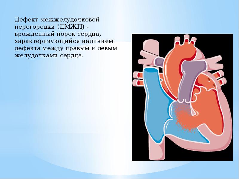 Тетрада фалло презентация