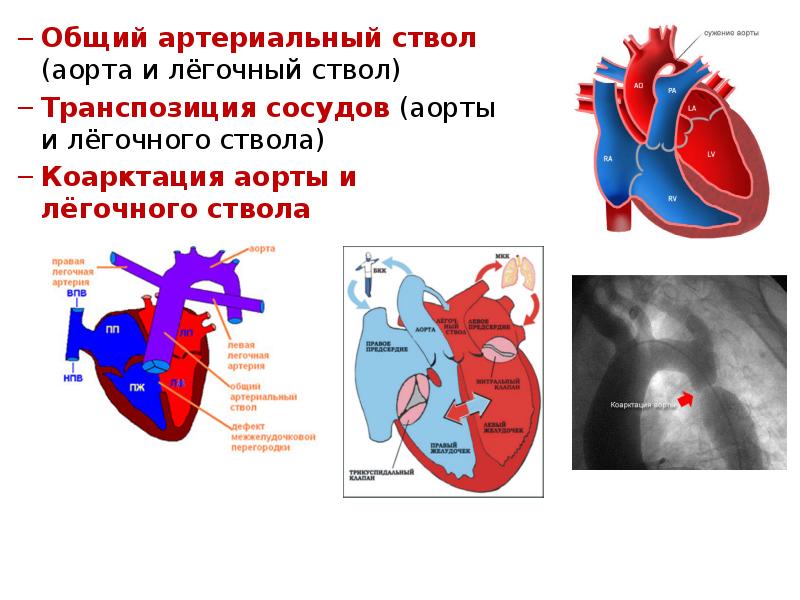 Клапаны аорты и легочного ствола. Общий артериальный ствол. Магистральный артериальный ствол. Легочный ствол. Общий артериальный ствол у новорожденного.