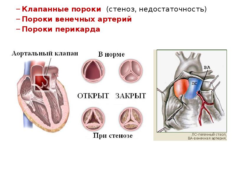 Аортальные пороки сердца презентация