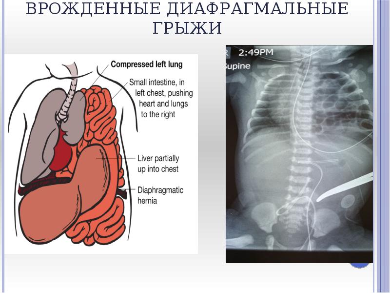 Презентация грыжи диафрагмы