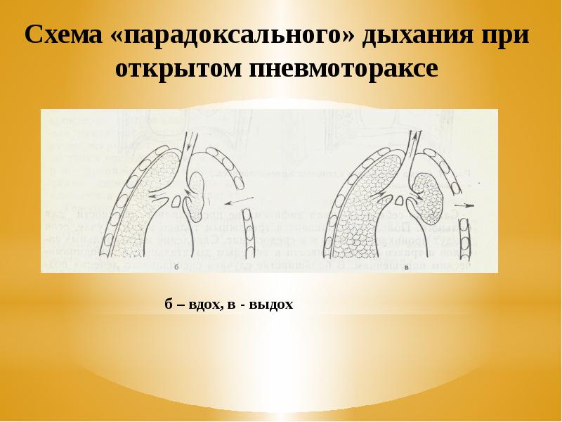 Пневмоторакс хирургия презентация