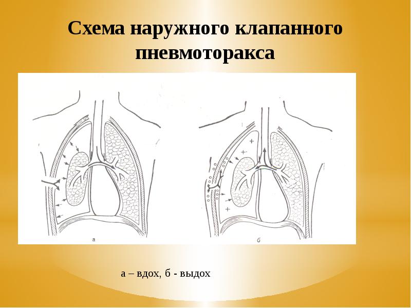 Пневмоторакс картинки для презентации