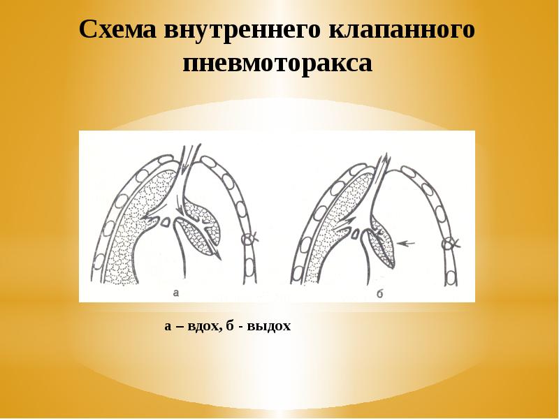 Клапанный пневмоторакс презентация