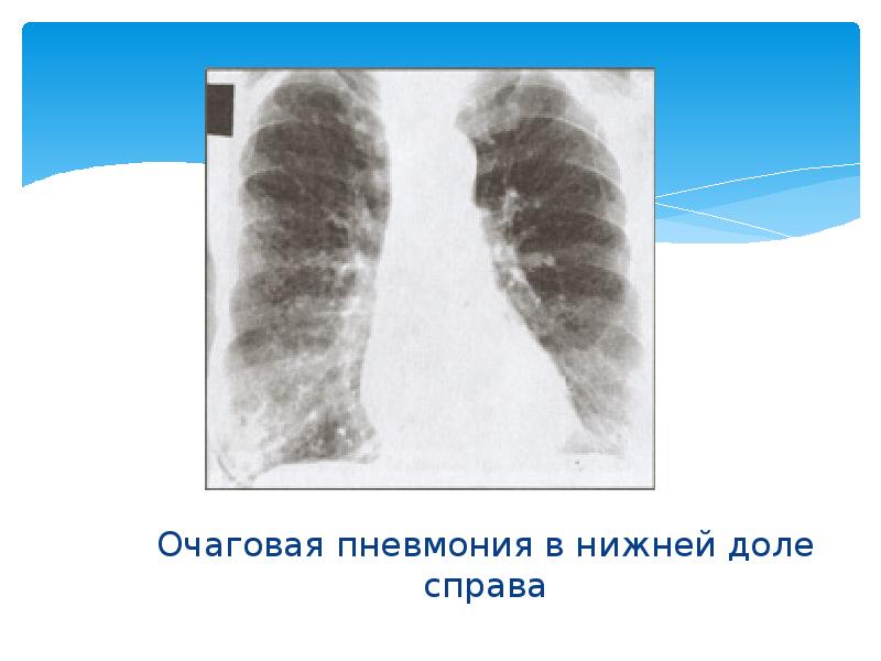 Очаговая пневмония презентация