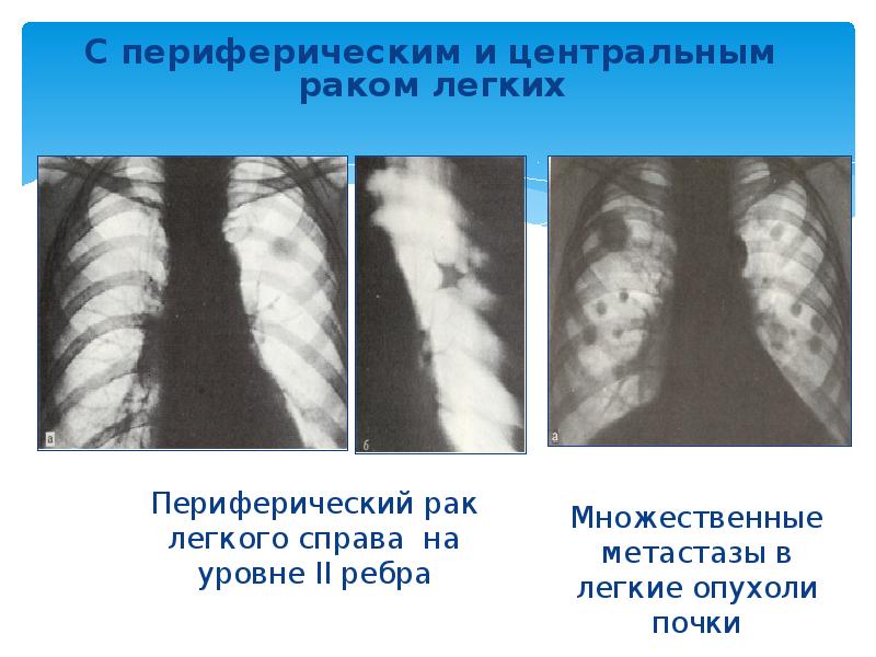 Лучевая картина центрального периферического и метастатического рака легкого